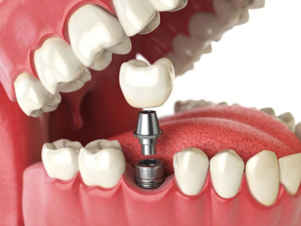 Affordable dental implants help address issues with missing teeth