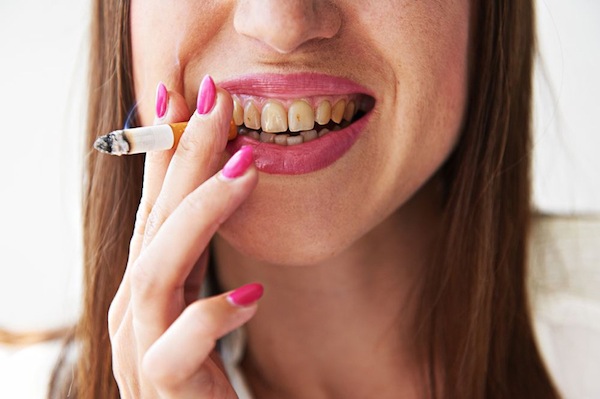 It's Best to Stop Smoking If You’re Planning to Get Dental Implants