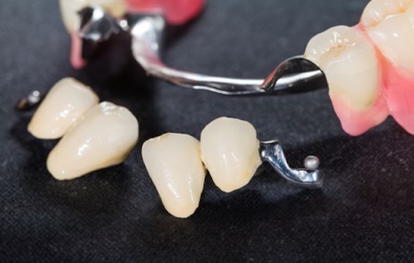Image of Partial Dentures - ProDentures, Houston TX