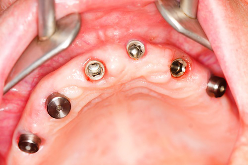 Image of Houston Denture Patient with an Elder Dentist - ProDentures, Houston TX